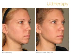 Ultherapy Before & After Face